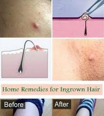 Learn about ingrown hair removal. 900 Ingrown Hair On Buttocks Ideas Ingrown Hair Simple Skincare Ingrown Hair Remedies