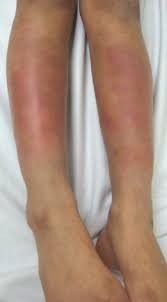 Image result for erythema nodosum