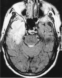 Image result for HSV Encephalitis