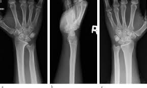 Dont panic , printable and downloadable free distal radioulnar joint functional anatomy including we have created for you. Arthroscopic Resection Of An Osteochondral Loose Body In The Distal Radioulnar Joint A Case Report Sciencedirect