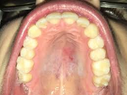 Tiny chips or cracks may not be a bother. Red Spots On Roof Of Mouth Causes And Other Symptoms