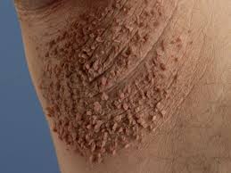 Fibroma