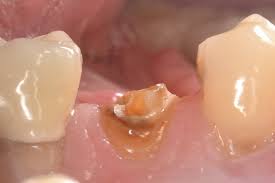Das erste warnsignal für karies ist eine gesteigerte empfindlichkeit der zähne bei mit zahnkaries, kariesarten und zahnerosionen bzw. Erhalt Extrem Zerstorter Zahne Zahnarzt Koln Maarweg