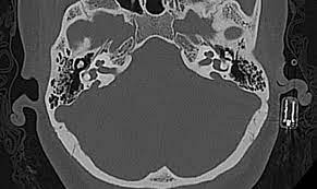 Large Vestibular Aqueduct Syndrome Radiology Case Radiopaedia Org
