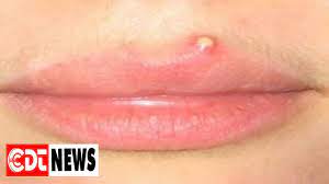 Repeat till you see the size of the pimple decreasing. 9 Simple Ways To Get Rid Of Pimples On Your Lips Cdt News Youtube