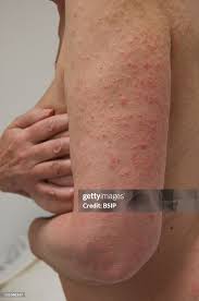 Image result for polymorphous eruption
