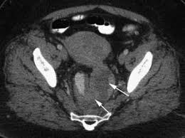 Endometriosis can affect women of any age. Tumors Of The Uterine Corpus Clinical Gate