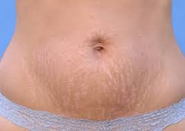 Essential Ways To Tighten Loose Skin After Pregnancy Kingdom Of Baby