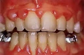 Protheses Dentaires Et Incidences Sur Les Intestins Colopathie Et Protheses Dentaires Dentaire Les Intestins Gencive