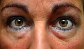 Bolsas En Los Ojos Como Luchar Contra Este Problema Mejor Con Salud Besser Gesund Leben Falten Unter Den Augen Schonheitstricks
