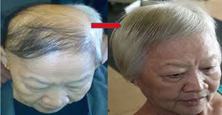 как ускорить рост волос на голове в домашних условиях Nanesite 2 Kapli I Izbavtes Ot Zalysiny Potryasayushij Effekt Lost Hair Grow Hair Hair Loss