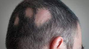 · minerali e oligoelementi se carenti, perché importanti per la salute dei capelli. Perdita Dei Capelli Quando E Importante Rivolgersi Al Medico Insalaco Clinic