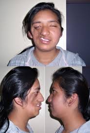 Check spelling or type a new query. Parry Romberg Syndrome Wikipedia