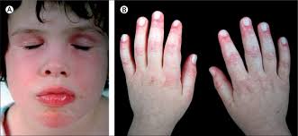 Juvenile dermatomyositis and other idiopathic inflammatory myopathies of  childhood