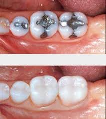 Sind füllungen aus amalgam gesundheitsschädlich? Zahnfullung Keramik Oder Amalgam