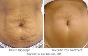 This includes stretch mark creams, oils, and lotions. 13 Incredible Radiofrequency Tightening Transformations