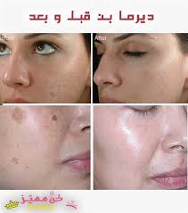 جهاز ديرما بن الجلسات و الفوائد و تجربتي قبل و بعد بالصور لجهاز dermapen dermapen sessions benefits and experience before dermapen nose ring nose