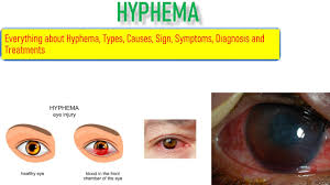 Image result for Hyphema