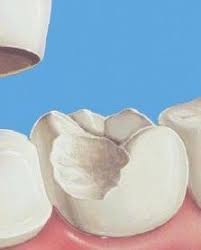 Consuetūdo est altĕra natūra tanta vis probitātis est, ut eam etiam in hoste diligāmus. Visul Este Rupt Ce ViseazÄƒ Un Dinte Frontal Rupt