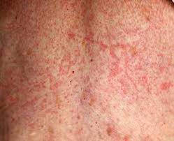 Pin On Drug Allergy