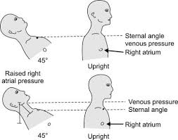 Image result for Venous Hum