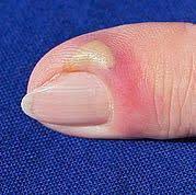 Finger Eitert Schmerzen Eiter Daumen
