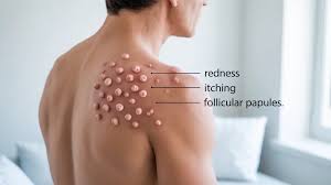 Image result for folliculitis symptoms