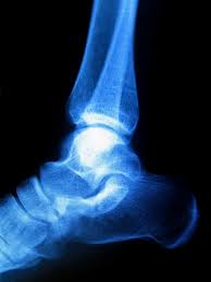 Haglund's deformity is a medical condition characterized by enlargement of bone at back of heel bone. Podiatrist In Mauldin Haglund S Deformity In Mauldin Oak Tree Podiatry Pa