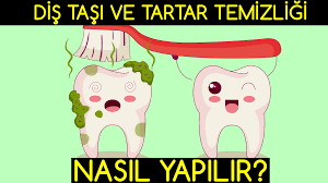 Kavitron ultrsonik titreşimler yayarak diş taşlarını diş yüzeyinden ayırır. Dogal Yollarla Dis Tasi Ve Tartar Temizligi Nasil Yapilir Sifa Bul