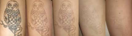 We've created a page dedicated to before and after images of our own client's tattoo removal journeys. Tattoo Removal Vida Aesthetic Medicine Salem Oregon