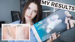 Are there are side effects to using a laser hair removal system? My Results Laser Hair Removal At Home Ipl Review Braun Silk Expert Pro 5 Youtube