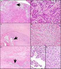 A, the spindle tumor cells were arranged in bundles and whirling patterns. Pathologic Considerations And Standardization In Mesothelioma Clinical Trials Sciencedirect