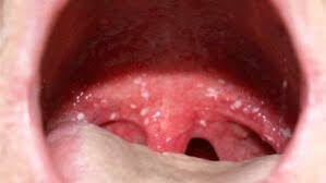 Image result for Canker sores symptoms roof of the mouth