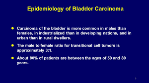 Smoking tobacco is the most important known risk factor for bladder cancer. Ø£ÙˆØ±Ø§Ù… Ø§Ù„Ù…Ø«Ø§Ù†Ø© Bladder Cancer Dr Alseoudi Alhadi Ø¯ Ø§Ù„Ù‡Ø§Ø¯ÙŠ Ø§Ù„Ø³Ø¹ÙˆØ¯ÙŠ Albairouni C H U Ppt Download