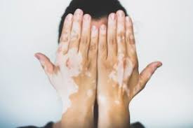 Image result for Vitiligo