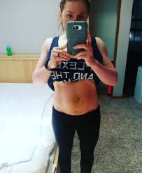 10 Days Postop With Umbilical Hernia Repair Still Quite A Bit Of Swelling And Bruising But Recovery Umbilical Hernia Umbilical Hernia Repair Girls Who Squat