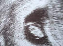 8 Ssw Schwangerschaftswoche Dein Baby Dein Korper Beschwerden Und Mehr Faminino