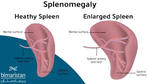 Image result for Splenomegaly