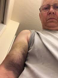 Finished 1000 piece jigsaw puzzle after injury