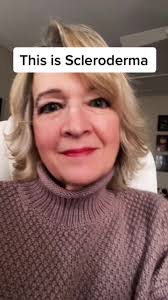 Faith and Hope in the Face of Scleroderma: A Boost of Hope