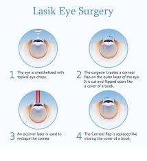 Everything you need to know about lasik eye surgery and what it's like before, during, and after lasik eye surgery. What Does Lasik Eye Surgery Feel Like Optilase Laser Eye Surgery