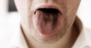 Image result for black hairy tongue symptoms