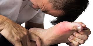 Cedera pergelangan kaki umumnya dikeluhkan oleh sebagian orang dimana ruas pergelangan kaki mengalami keterbatasan gerak karena sakit dan nyeri hal tersebut menyebabkan inflamasi menjadi bertambah parah sehingga pasien harus di lakukan tindakan edukatif agar kedepannya gejala cedera. 5 Ciri Ciri Asam Urat Yang Harus Diwaspadai Halaman All Kompas Com