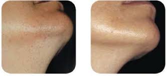 It reduces the hair growth. Laser Hair Removal Eshaan Laser And Skincare Medical Spa