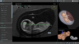 Image result for First Trimester Ultrasound