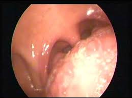 Andrew ordon explains the tiktok trick may help to stimulate both your sense of smell and taste simultaneously and the combination of the citrus and sugar could lead to a reboot or reprogramming of your senses. Throat Normal Taste Buds Not Cancer Youtube