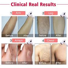 See more ideas about hair removal, hair removal diy, hair removal permanent. Laser Hair Removal For Women Men Imene 500 000 Flashes Ipl Permanent Hair Removal Upgrade