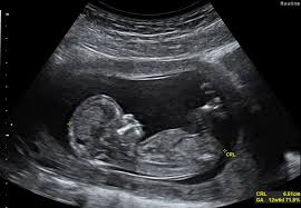 The 1st trimester, july 2017. Early Pregnancy Scan Reassurance Scan