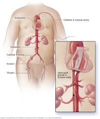 Thoracic Aortic Aneurysm Diagnosis And Treatment Mayo Clinic