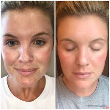 Check spelling or type a new query. Laser Treatment Microneedling Results The Southern Style Guide
